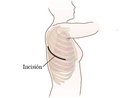 Información sobre su cirugía de tórax | Memorial Sloan Kettering Cancer Center