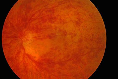 Central Retinal Vein Occlusions - Retina Consultants Of Michigan