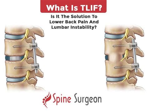 What is TLIF? Is it the solution to lower back pain and lumbar ...