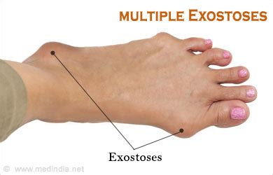 Exostoses / Multiple Non-cancerous Bone Tumors - Causes, Symptoms, Diagnosis and Treatment