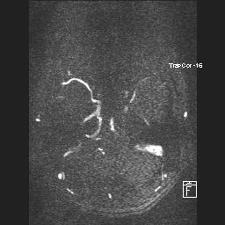 Dural venous sinus thrombosis | Image | Radiopaedia.org