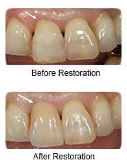 Manhattan Dentist | All-Ceramic Dental Crowns