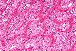 Fibrous dysplasia - Libre Pathology