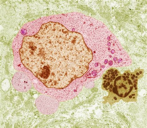 Seminoma cancer cell, TEM - Stock Image - C026/2806 - Science Photo Library