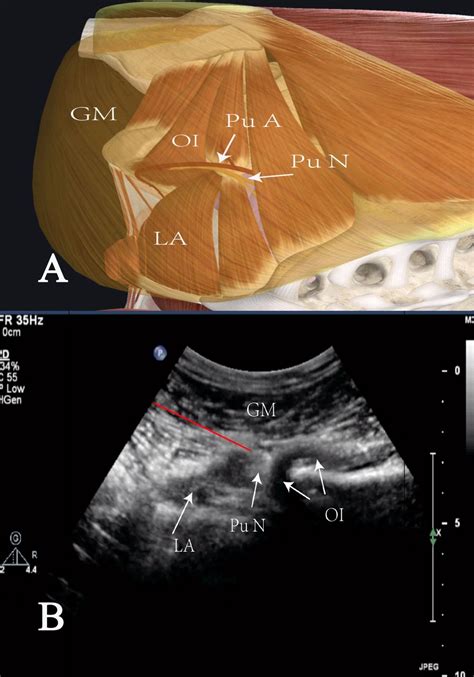 Bilateral Pudendal Nerve Block