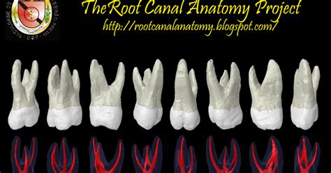 The Root Canal Anatomy Project: Maxillary First Molar