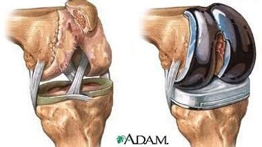 Bone Spurs In Knee: Causes, Symptoms & Treatment Of Knee Osteophytosis