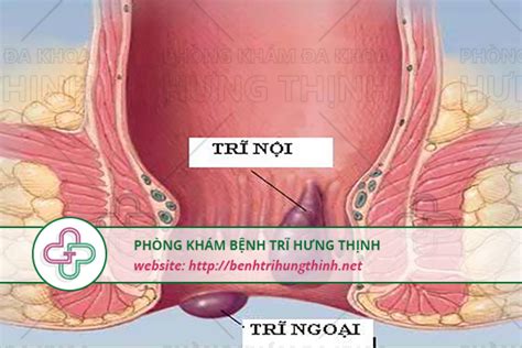 #1.Thế nào là bệnh trĩ ngoại? - Cách điều trị bệnh trĩ ngoại tận gốc