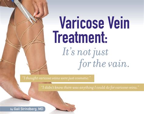 Varicose Vein Treatment | Northpointe Medical