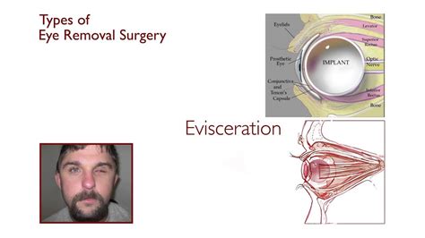 Eye Removal Surgeries - YouTube