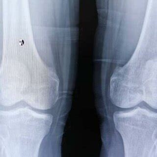 Plain X-Ray of the bilateral knee, AP view. The yellow arrow indicates... | Download Scientific ...