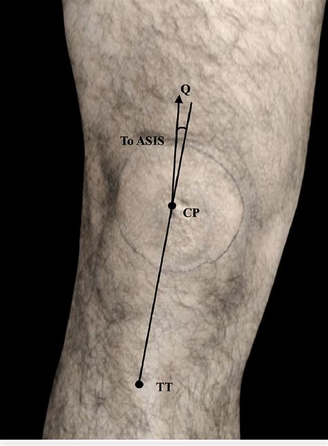 Measurement of Q angle of the left knee ASIS: anterior superior iliac ...