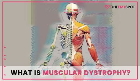 What Is Muscular Dystrophy Anyway? | TheEMTSpot