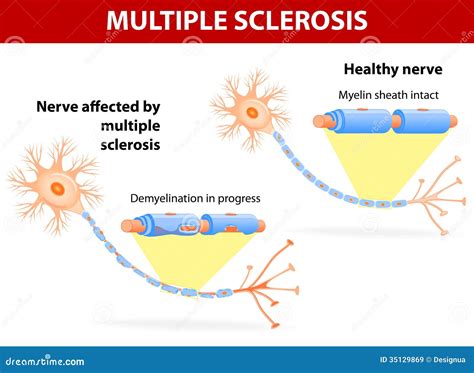 Multiple Sclerosis Banner. Symptoms, Causes, Treatment. Vector Signs ...