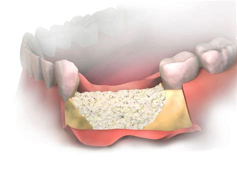 Bone Grafting Recovery: Tips and What to Expect Post-Procedure