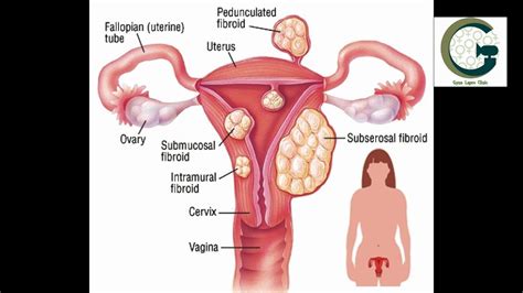 Patient Info: Fibroid removal surgery by laparoscopy - YouTube