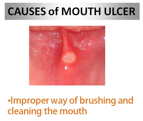 Mouth Ulcers : Causes, Picture, Symptoms And Treatment