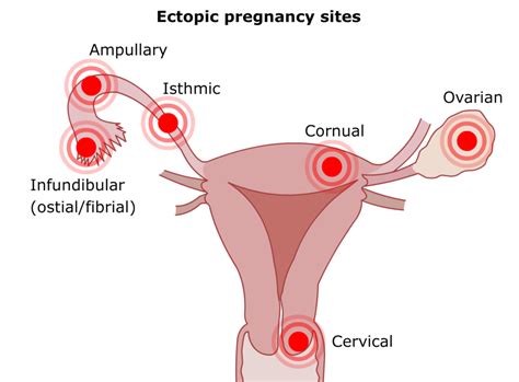 Ectopic Pregnancy - RCEMLearning India