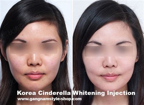 Korea Cindella skin whitening injection, most popular Glutathione injection