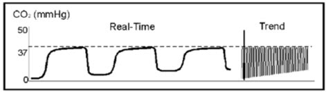 emDOCs.net – Emergency Medicine EducationInterpreting Waveform ...