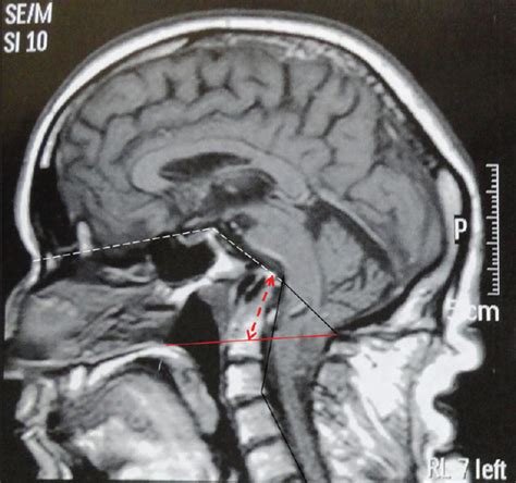 The odontoid process invagination in normal subjects, Chiari malformation and Basilar ...