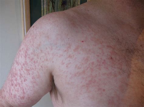 Viral Exanthem Rash: Sudden, All-Over Symptoms to Treat