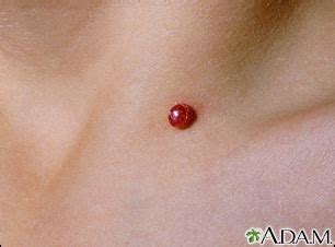 Pyogenic granuloma Information | Mount Sinai - New York