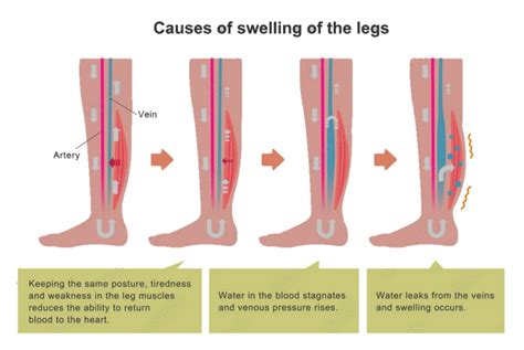 Signs of Edema: How To Reduce Leg Swelling - Precision Vascular