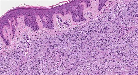 Dermatofibrosarcoma protuberans (DFSP) - MyPathologyReport.ca