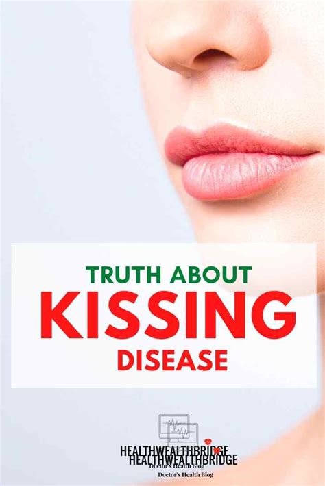 Kissing disease: The kiss of the virus (Infectious Mononucleosis) - Healthwealthbridge