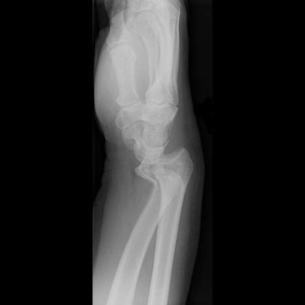 Smith fracture | Radiology Case | Radiopaedia.org