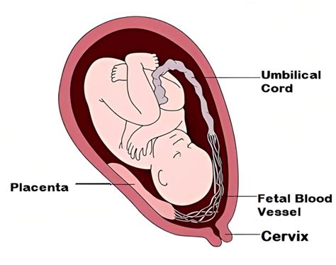 Vasa Previa: A Rare but Manageable Condition with a High Survival Rate ...