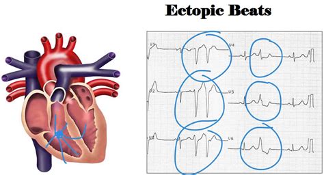 Ectopic beats causes, symptoms, diagnosis, treatment & prognosis