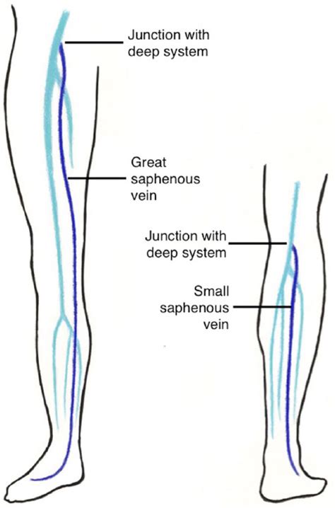 Superficial vein thrombosis - Natalie S Evans, Elizabeth V Ratchford, 2018