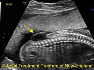 Spina Bifida Treatment Options and Information