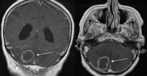 Cerebellum Brain Damage: Causes, Effects, and Rehabilitation