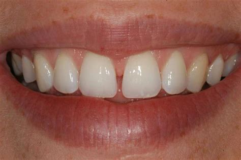 Diastema | News | Dentagama