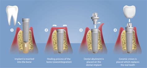 Dental Implants - Chandler Family Dentistry