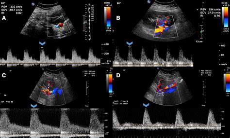 Renal Artery Stenosis Ultrasound