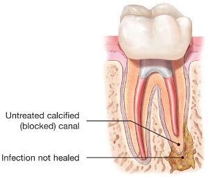 Endodontic Procedures, not just root canals