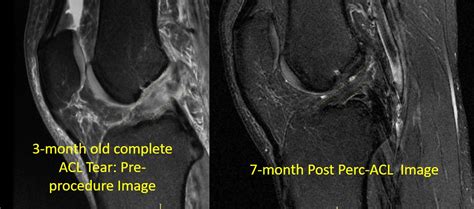 ACL Surgery Alternative? Meet the Perc-ACLR Procedure