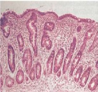 Subtotal villous atrophy | Download Scientific Diagram