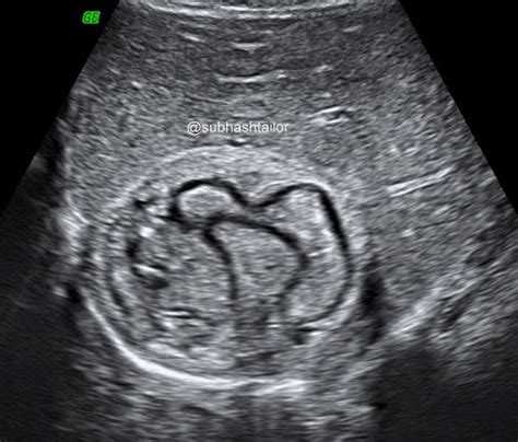 SONO DIGEST: ULTRASOUND IN HYDATID DISEASE