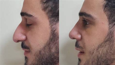 The Middle Eastern men having nose jobs - BBC News