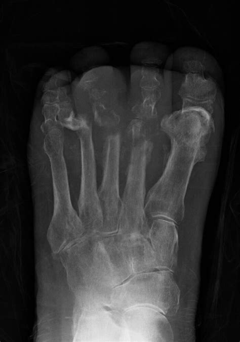 Osteomyelitis X Ray Features