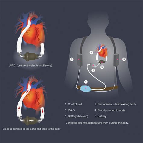 Left Ventricular Assist Devices (LVAD): Surgery and Treatment | NewYork ...