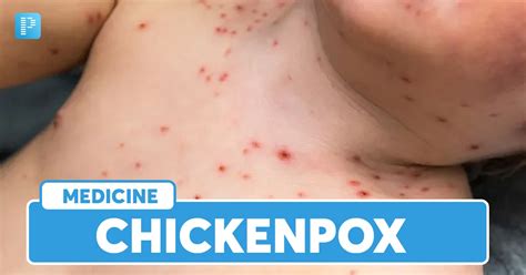 Chickenpox: Causes, Stages, Symptoms, Risk Factors, Diagnosis, Treatment and Complications