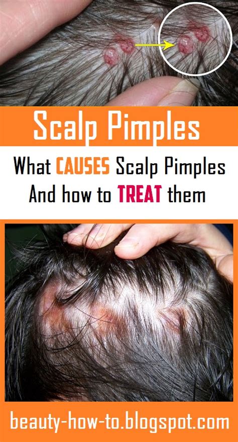 Scalp Pimples: What Causes them and how to Treat them - How To Beauty