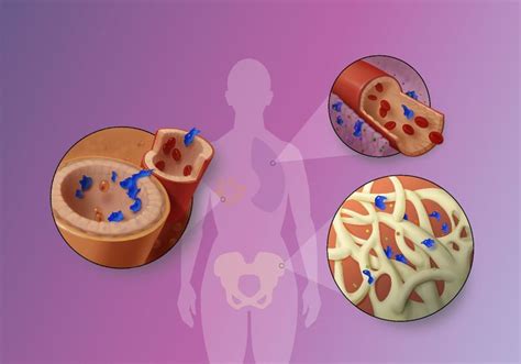 Infographic: Steps in Cancer Metastasis | The Scientist Magazine®