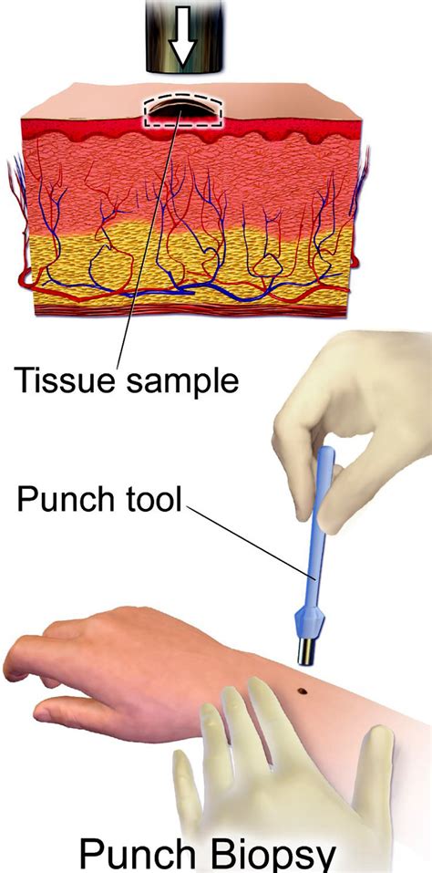 Skin punch biopsy method using a circular punch biopter [67 ...